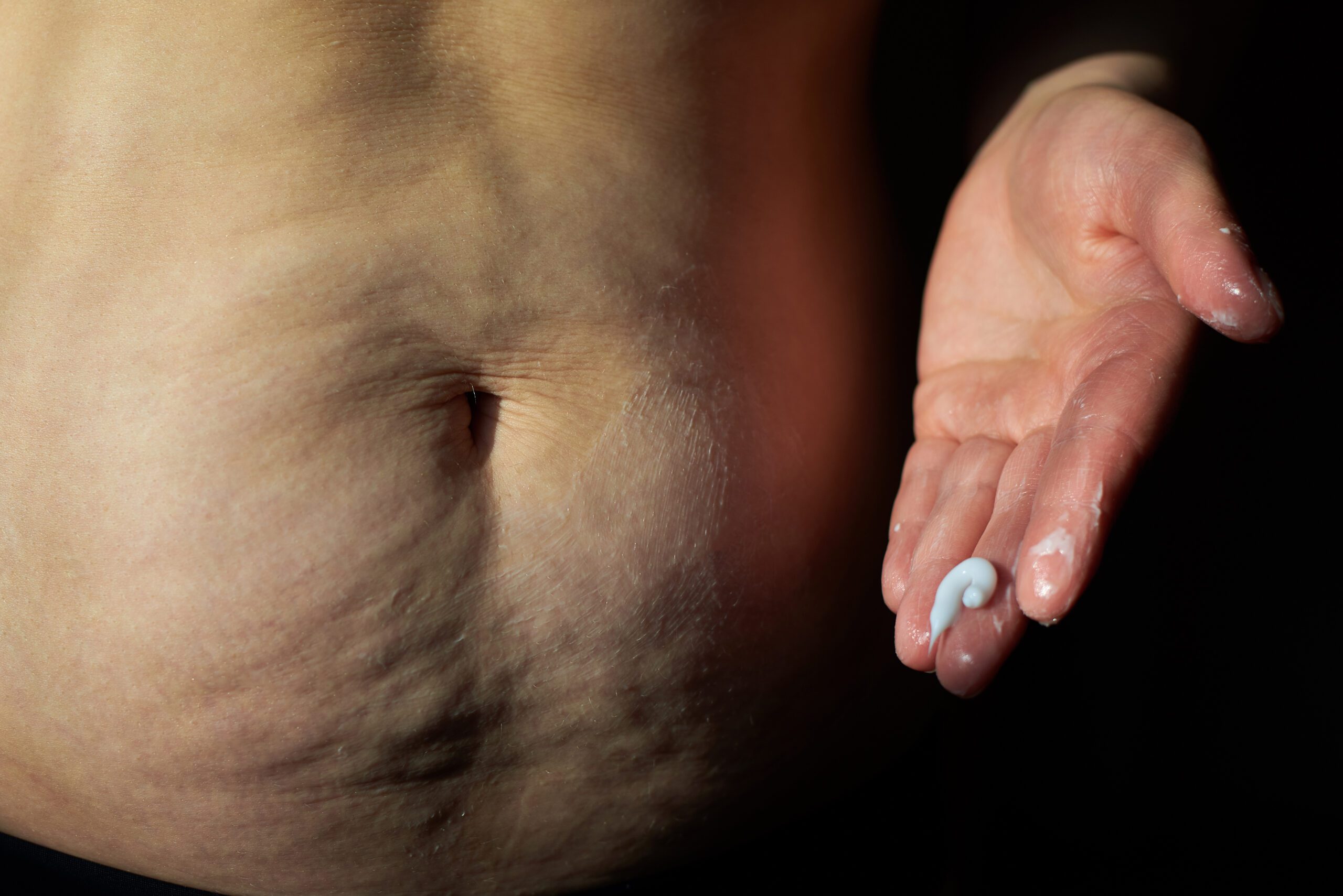 mulher apontando para barriga flacida