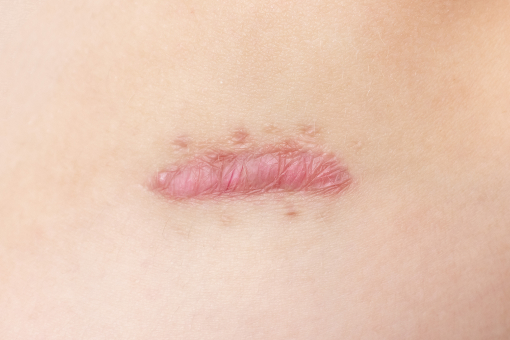 Imagem ilustrativa de uma cicatriz hipertrofica